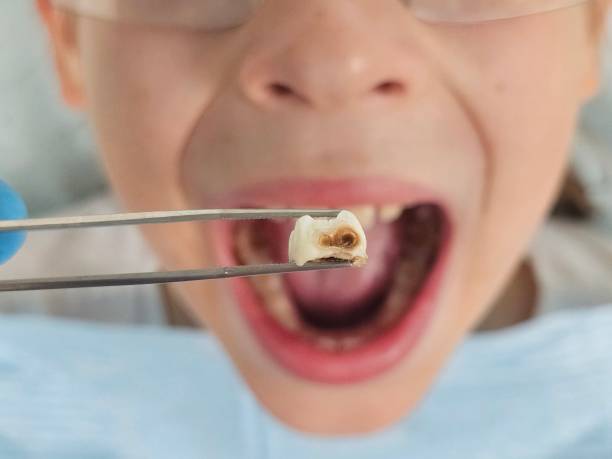 Best Emergency Tooth Extraction in Akron, CO