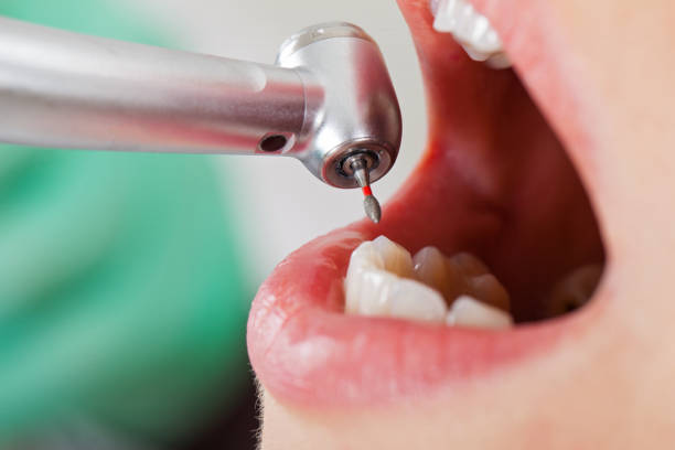 Best Urgent Care for Lost Fillings or Crowns in Akron, CO